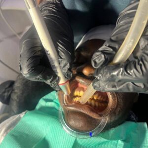 Teeth Whitening in Buea Cameroon Teeth Whitening in Buea Cameroon