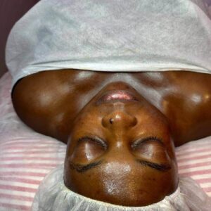 SKIN PEELS IN BUEA CAMEROON SKIN PEELS IN BUEA CAMEROON
