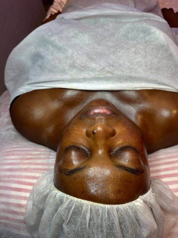 SKIN PEELS IN BUEA CAMEROON