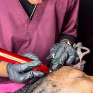 Skin tag removal in Buea Cameroon Skin tag removal in Buea Cameroon