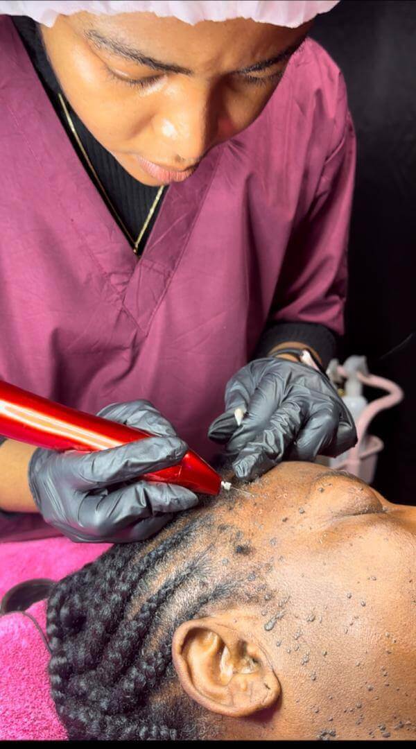 Skin tag removal in Buea Cameroon